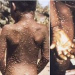 Monkeypox declared an international health emergency by the WHO