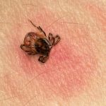Kyasanur forest disease, a tick-borne infection that scares India