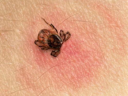 Tick,With,Its,Head,Sticking,In,Human,Skin,,Red,Blotches